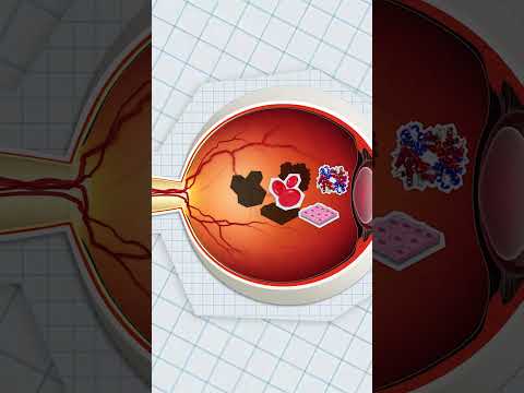 FLOATY THINGS IN YOUR EYE EXPLAINED